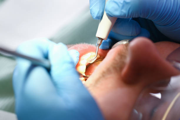 Best Emergency Tooth Extraction in St Simons, GA